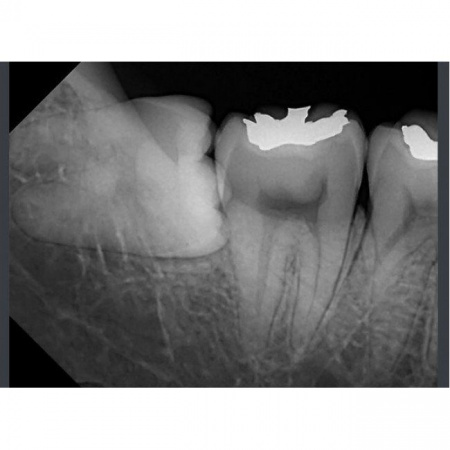 Цифровой радиовизиограф RIOSensor RIS500 (размер 2)
