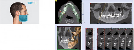 Стоматологический томограф NewTom 2D/3D GO