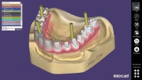 Модуль Exocad Implant module. Имплант модуль