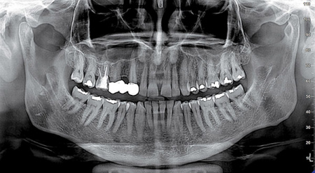 Стоматологический томограф NewTom 2D/3D GO