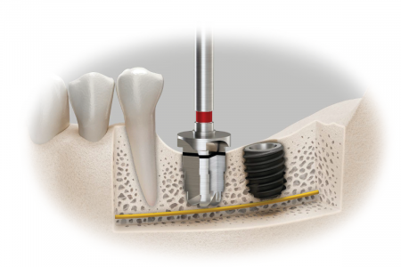 Хирургический набор 485 KIT для безопасной установки коротких имплантатов OSSTEM Implant (Южная Корея)