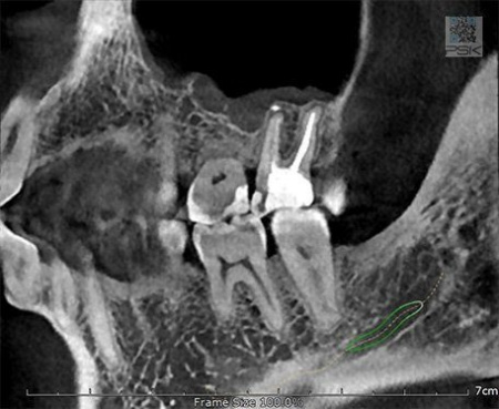 Компьютерный томограф GENORAY Papaya 3D 16x14, с цефалостатом