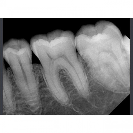 Цифровой радиовизиограф RIOSensor RIS500 (размер 2)