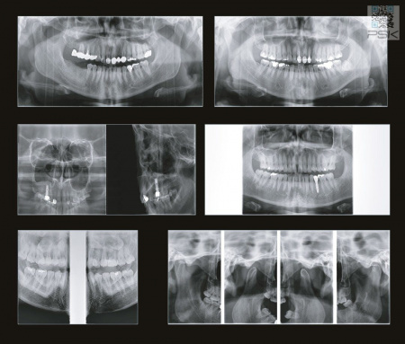 Компьютерный томограф GENORAY Papaya 3D 16x14, с цефалостатом